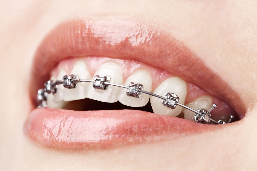 braces rudman dentistry