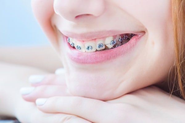 tips for choosing an orthodontist 0