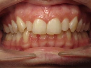 patient’s teeth before Invisalign