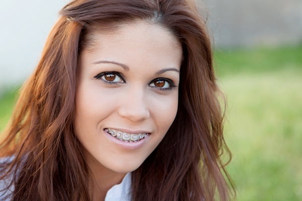 heres what you need to know about braces 5fa9600aa8537