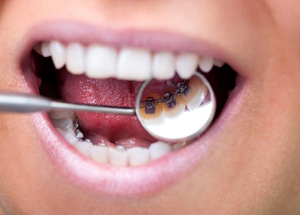 Incognito lingual braces being shown in a dental mirror on the back of someone's teeth