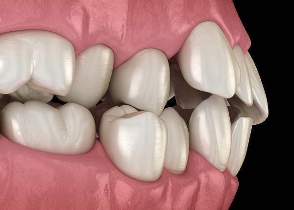 Close-up illustration of crooked teeth