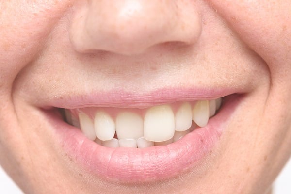 Woman With Crooked Teeth