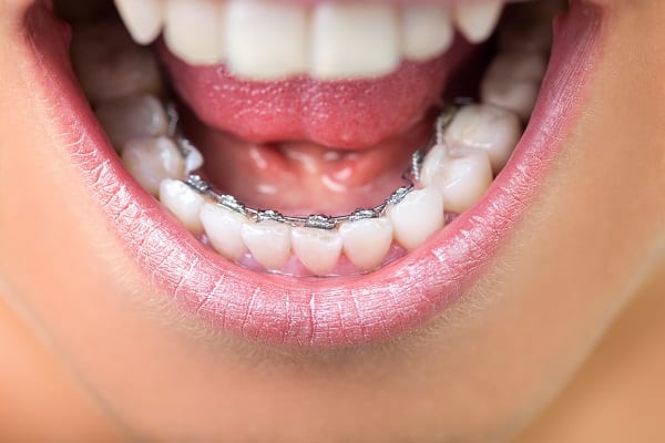 Lingual braces showing on the back side of the teeth