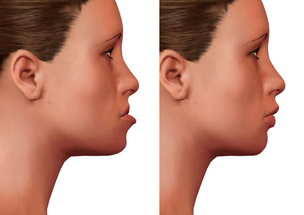 orthognathic surgery, correction of human mandible deformity, before and after, side view. 3D Rendering