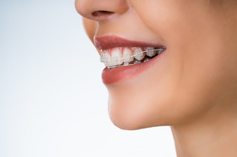 Woman wearing braces to fix overbite