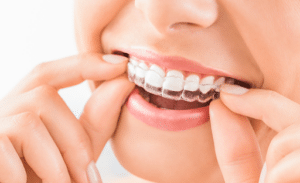 woman taking out Invisalign® treatment plastic aligners