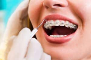 closeup young woman checking her braces smiling picture