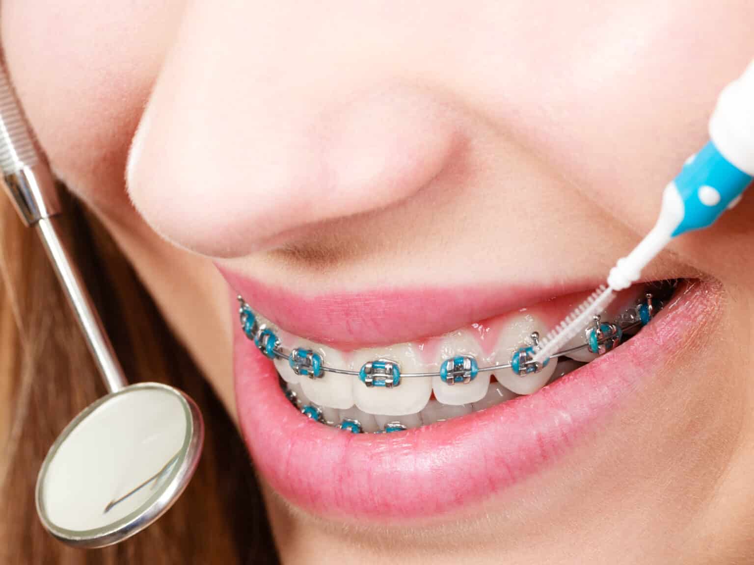 Do Orthodontists Clean Teeth?
