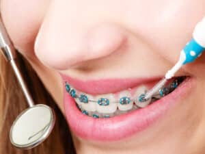 Dental,Health,Care,,Stomatology,Concept.,Woman,With,Braces,Having,Dentist