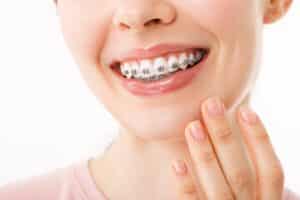 A close-up shot of a woman with braces smiling