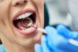 A close-up shot of lingual braces on a patient's teeth