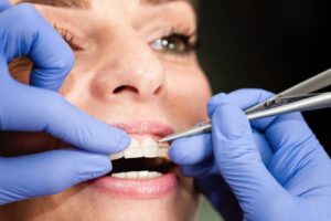 A close-up shot of an orthodontist putting ceramic braces on a woman's teeth