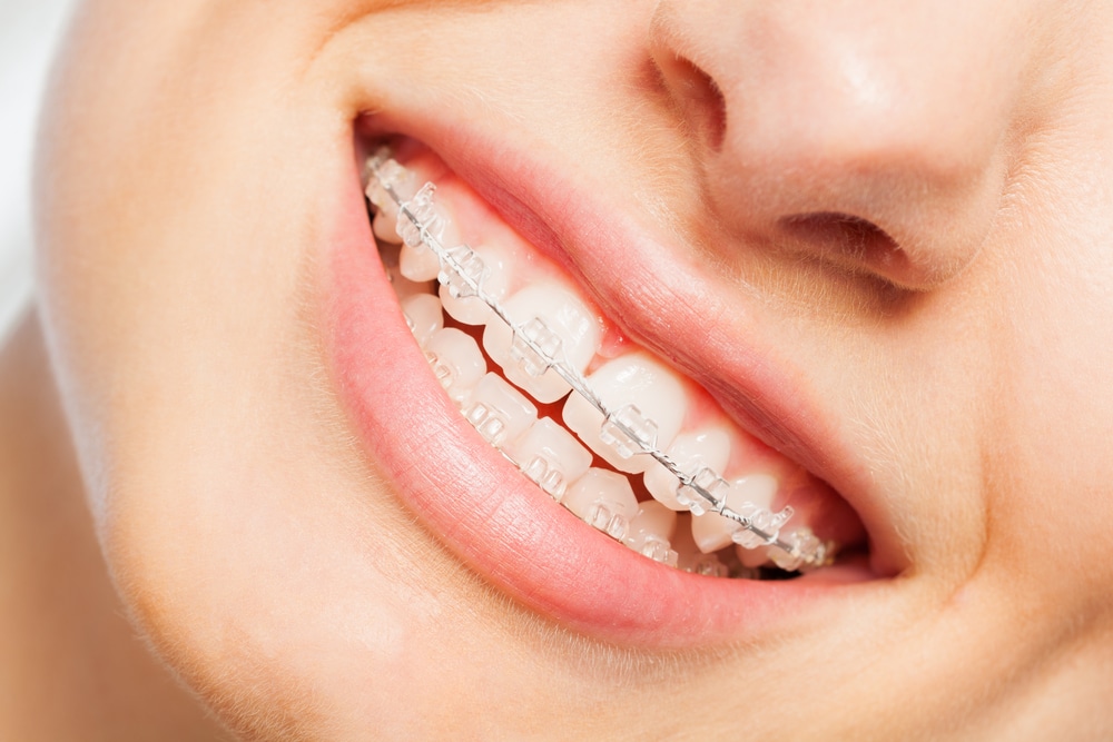1766076303 shutterstock 759381385 1 Ceramic Braces in Denver, CO