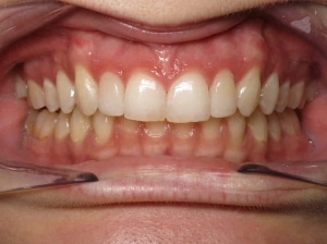 1766076513_anna-bozek-a-1 1766076513 anna bozek a 1 1 Invisalign in Denver, CO