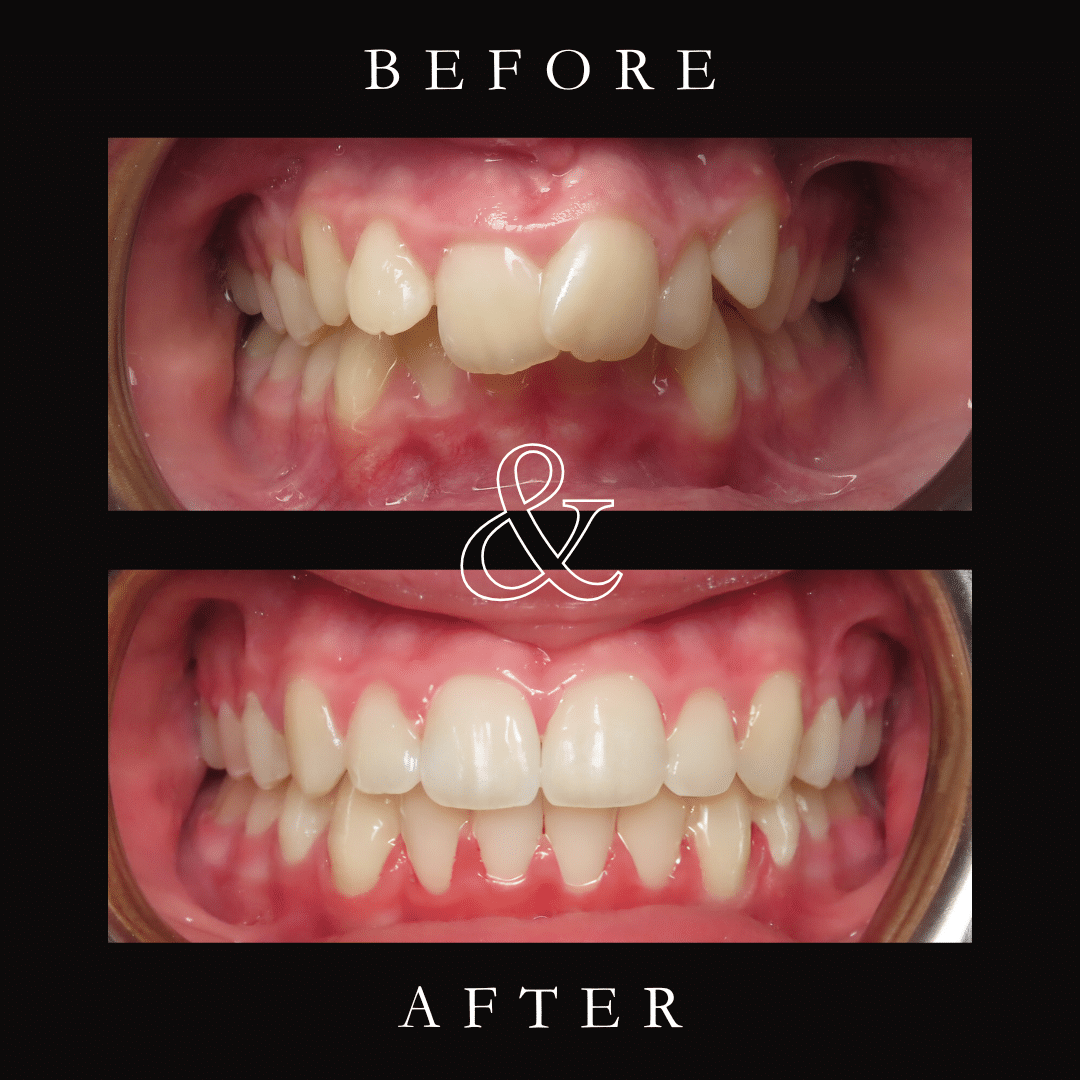 Before and After Image: Carriere Motion Appliance & Braces - front