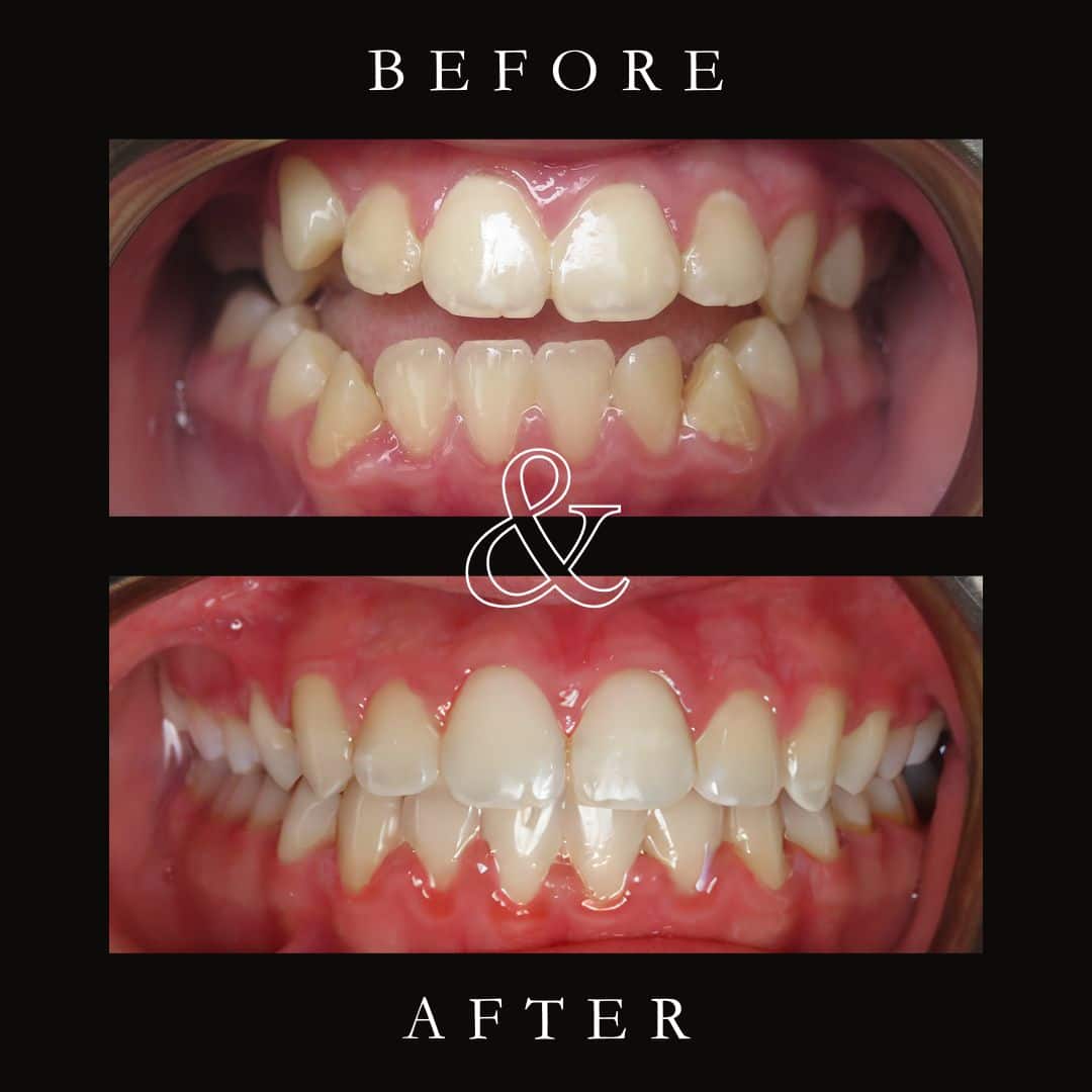 Before and After Image: Carriere Motion Appliance & Braces - front