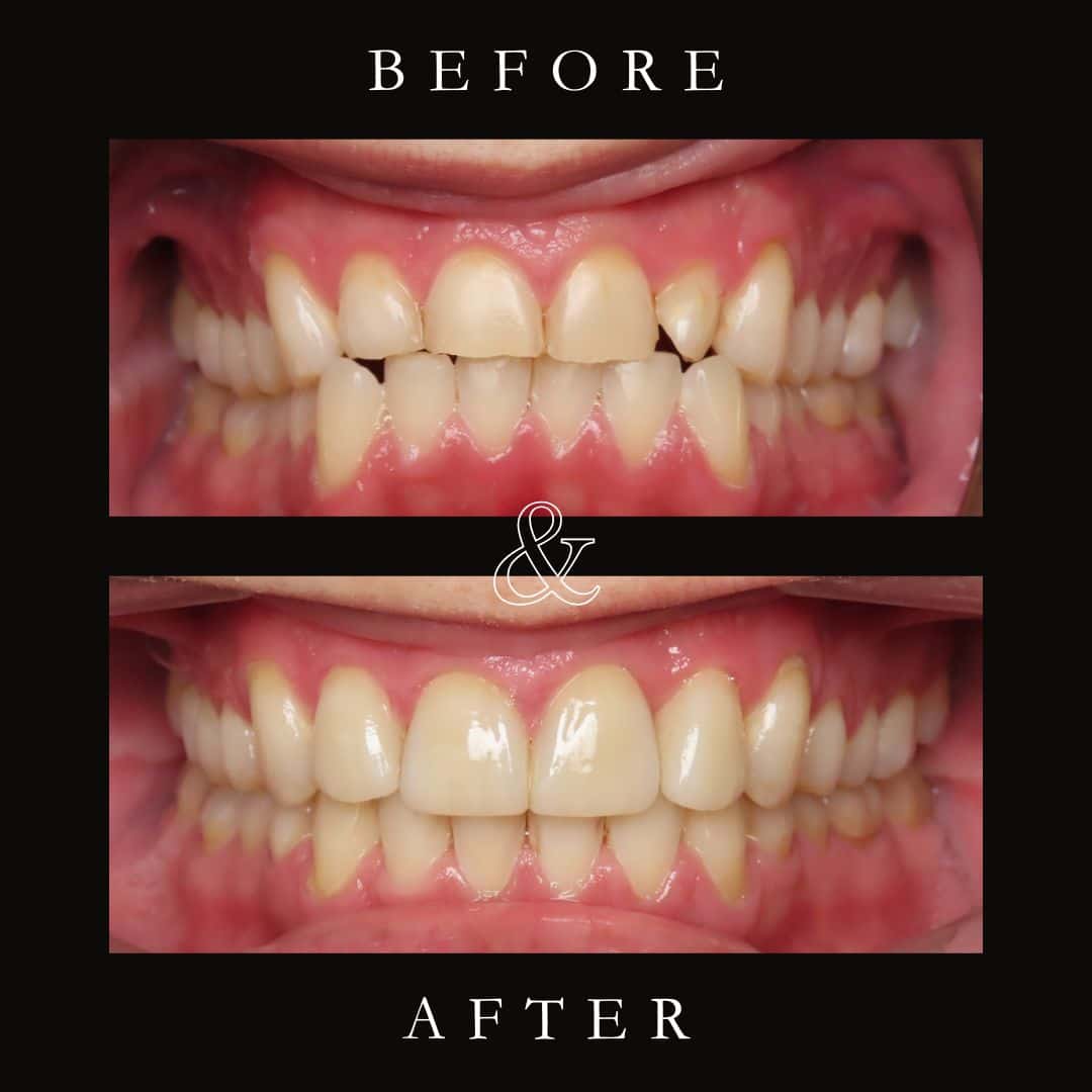 Before and After Image: Invisalign - front