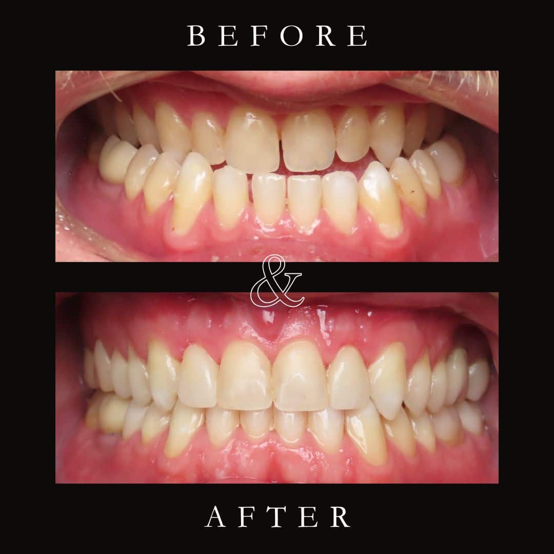 Before and After Image: Invisalign - front