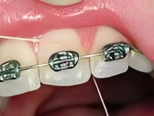 braces-2