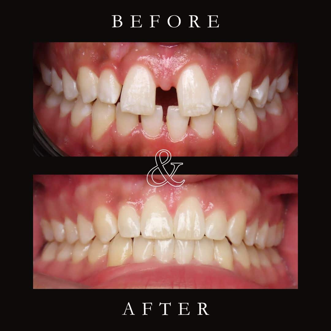Before and After Image: Invisalign - front